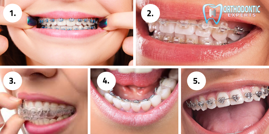 Different Types Of Braces Metal Lingual Ceramic And Wild Smile Braces