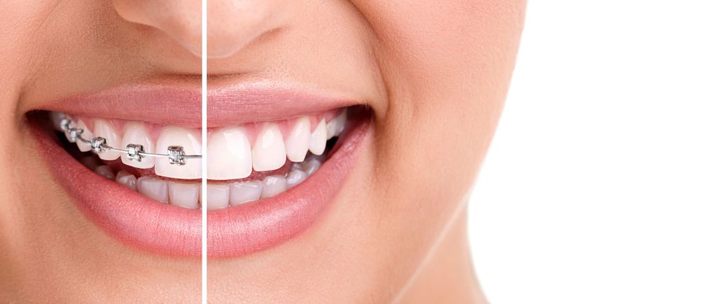 buffalo grove invisalign