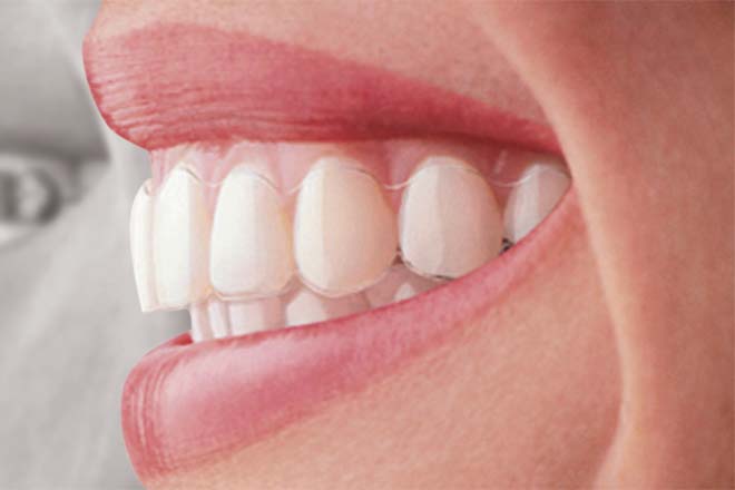 Park ridge invisalign