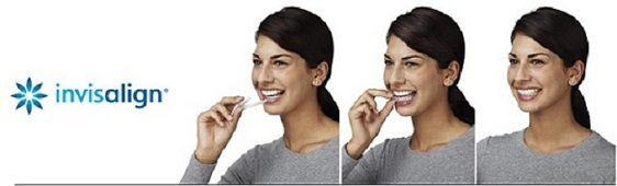 invisalign palatine il