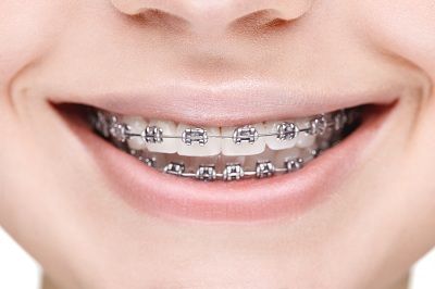 Traditional metal braces