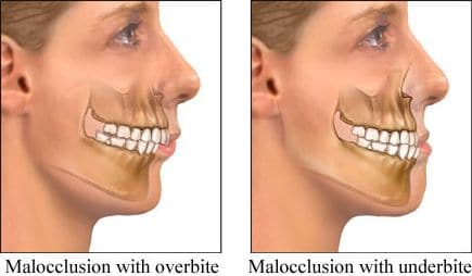 child overbite treatment