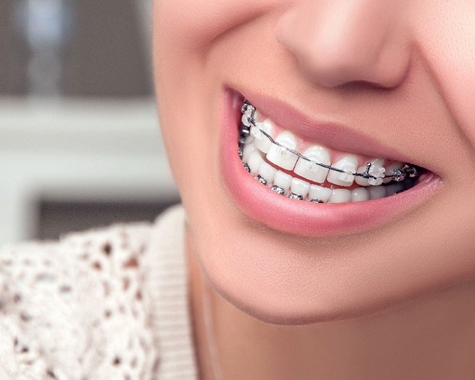 Clear vs Metal Braces
