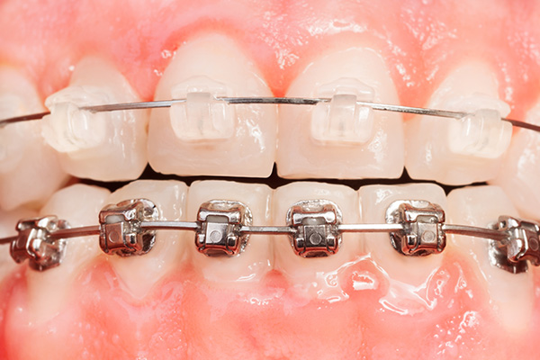 pros and cons of clear vs metal braces