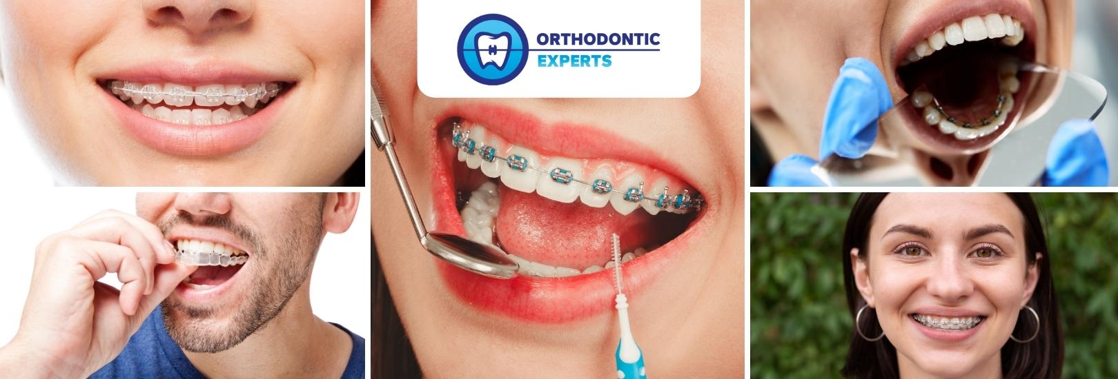 https://www.orthodonticexprts.com/wp-content/uploads/2018/10/Different-Types-Of-Braces-What-Are-They.jpg