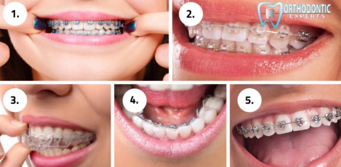 different kinds of braces