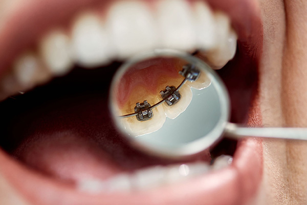 Lingual Braces