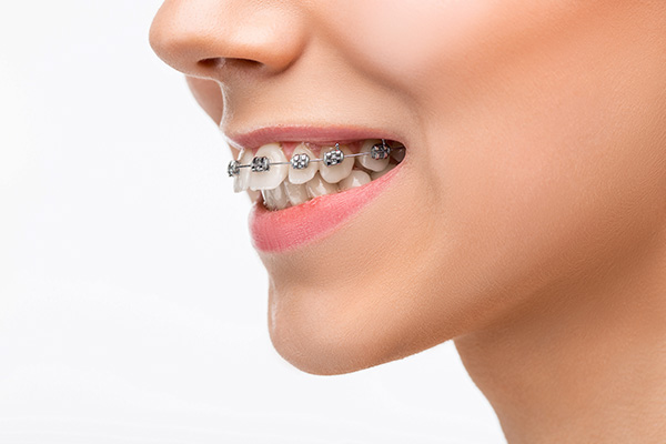 Different Types of Braces  Different kinds of Braces