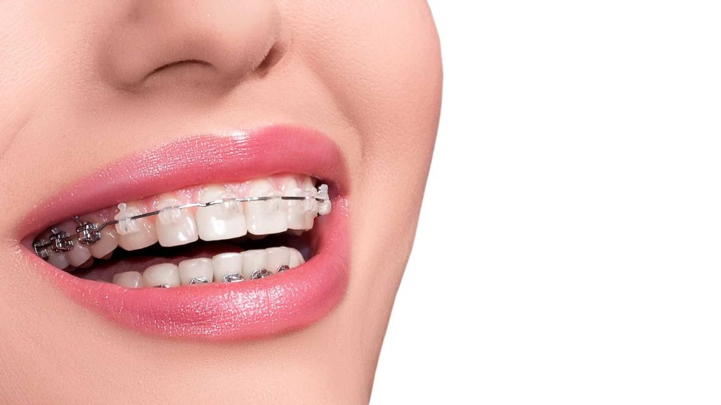 Ceramic Braces in Woodstock