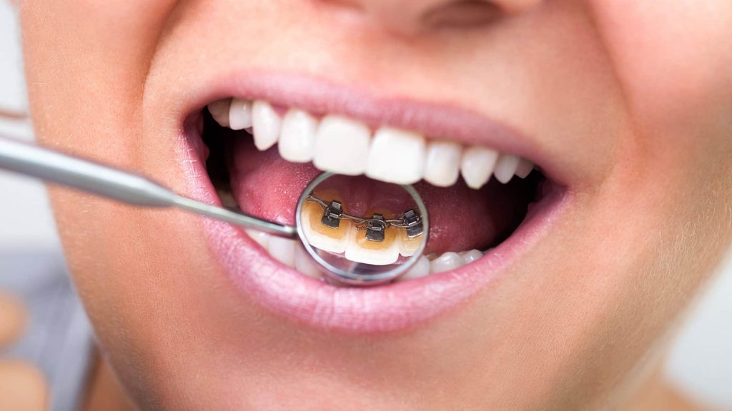 Lingual Braces