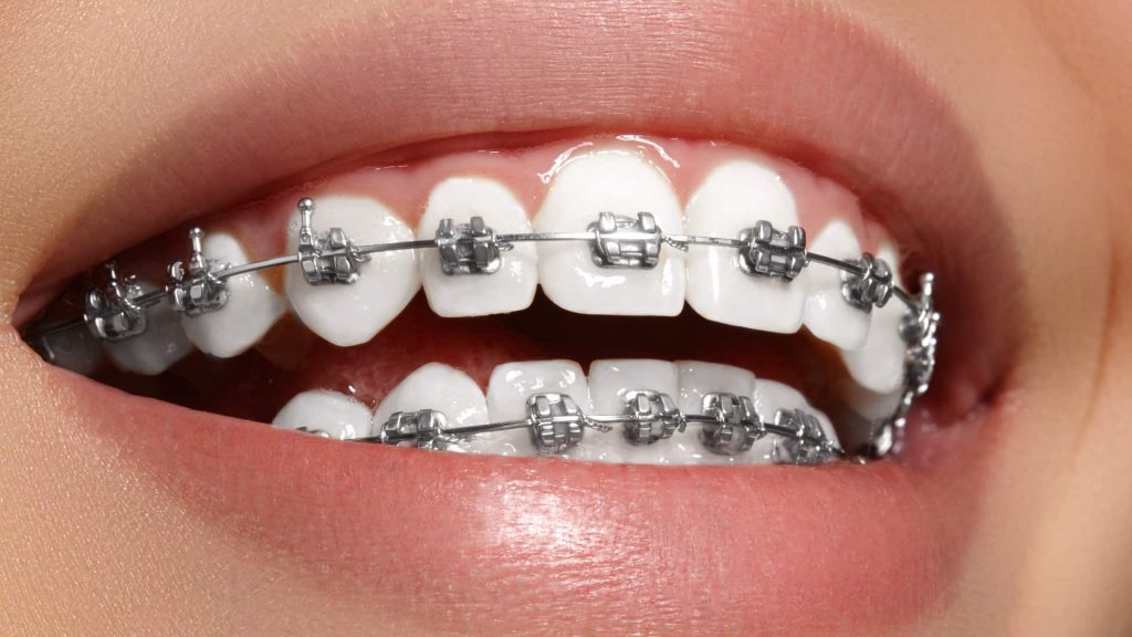 Traditional Metal Braces in Woodstock