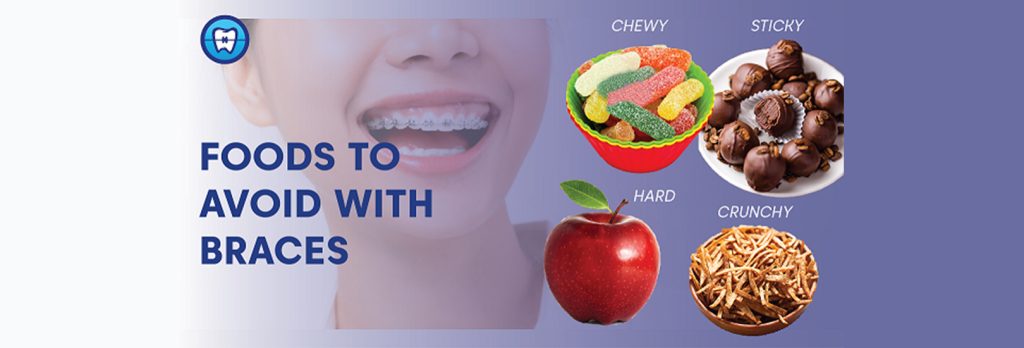 Foods to Avoid with Braces