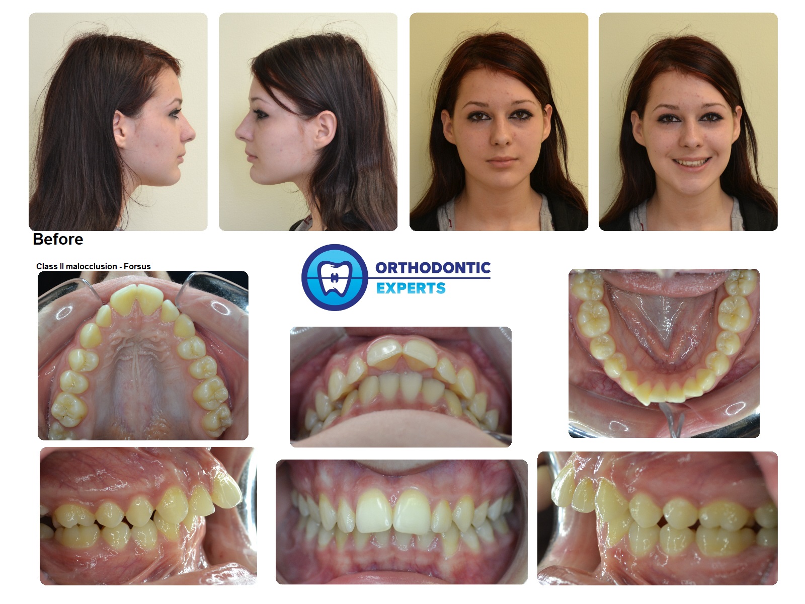 3.Forsus Top Orthodontist Braces, Invisalign