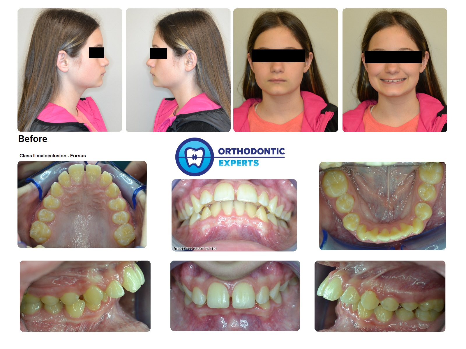 4.Forsus Top Orthodontist Braces, Invisalign