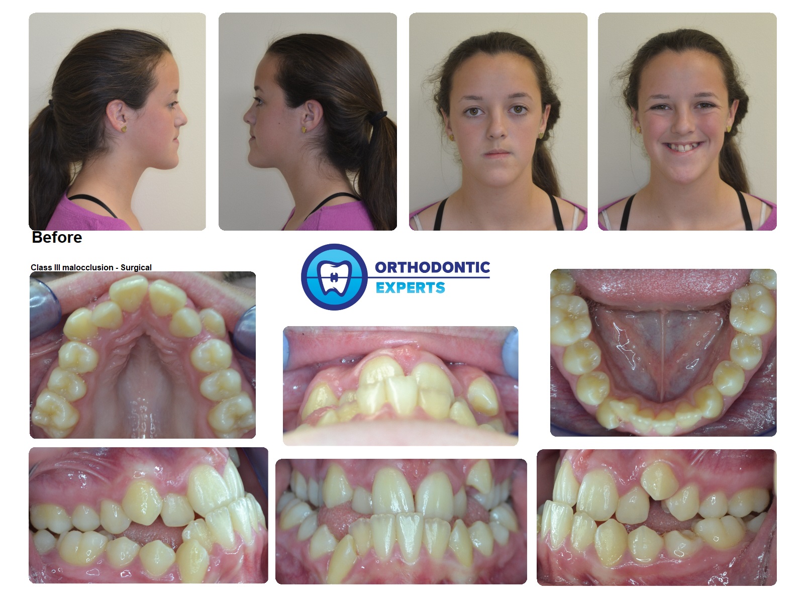 4.Surgical Top Orthodontist Braces, Invisalign