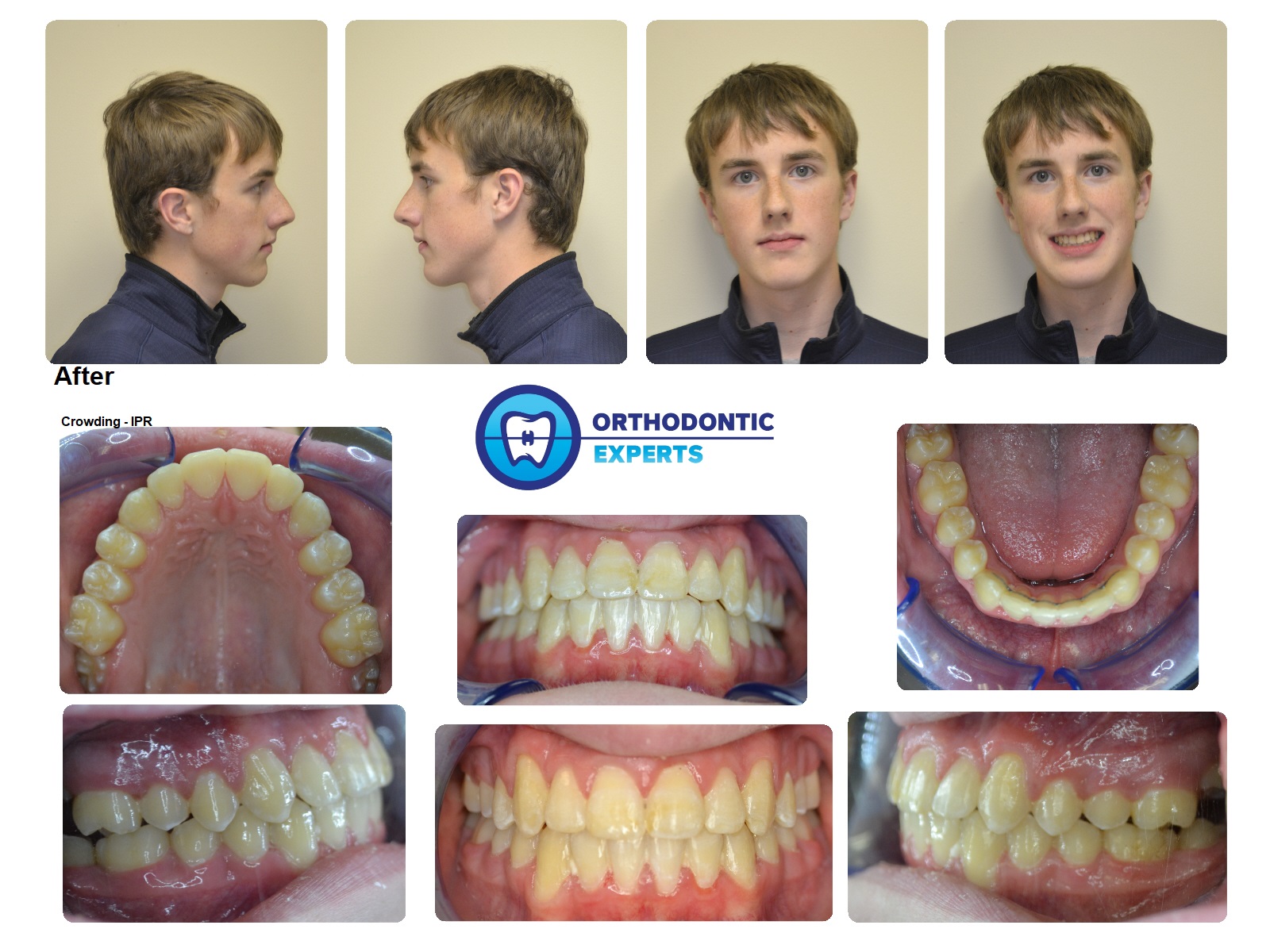 4IPR Top Orthodontist Braces, Invisalign