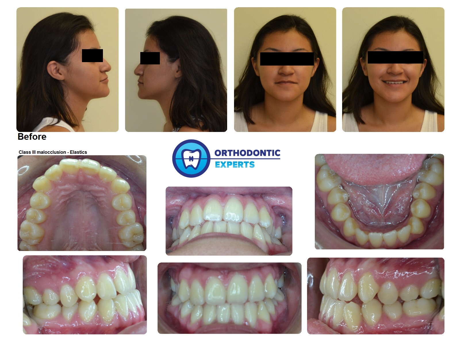 5.Elastics Top Orthodontist Braces, Invisalign
