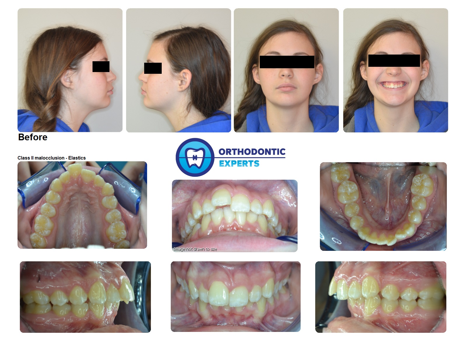 6.Elastics Top Orthodontist Braces, Invisalign
