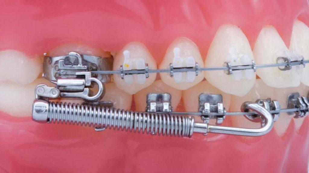 Forsus - Orthodontic Appliance