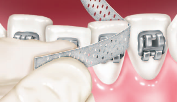 Interproximal Reduction (IPR) in Chicago