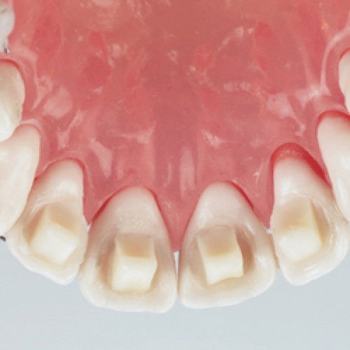 BiteRamps Top Orthodontist Braces, Invisalign