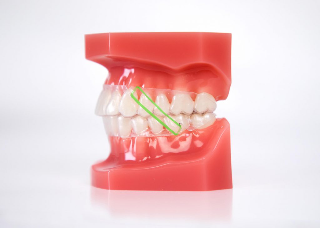 Class III Elastics - Orthodontic Experts