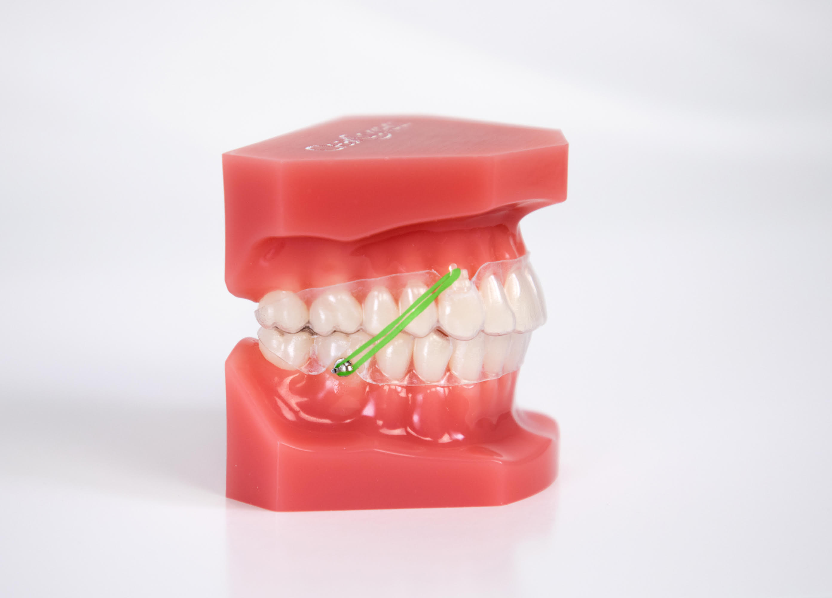 Class II elastics Top Orthodontist Braces, Invisalign