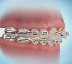 Elastics - Orthodontic Experts