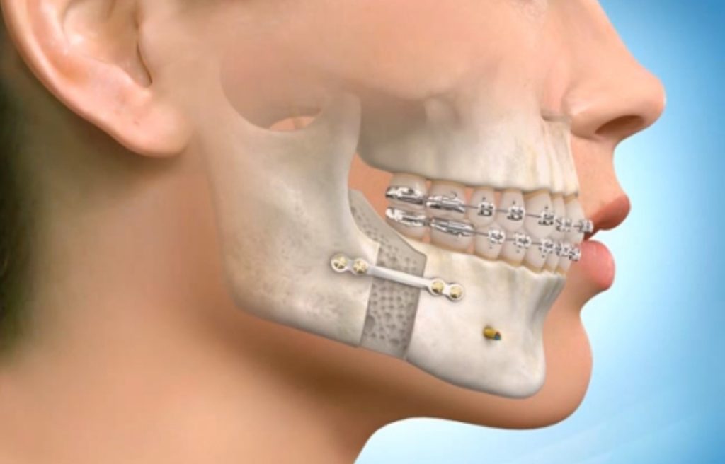 Surgical Orthodontics - Orthodontic Experts