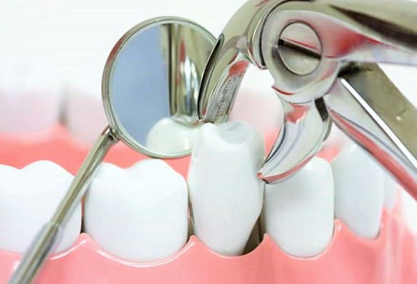 Tooth Extraction - Orthodontic Experts