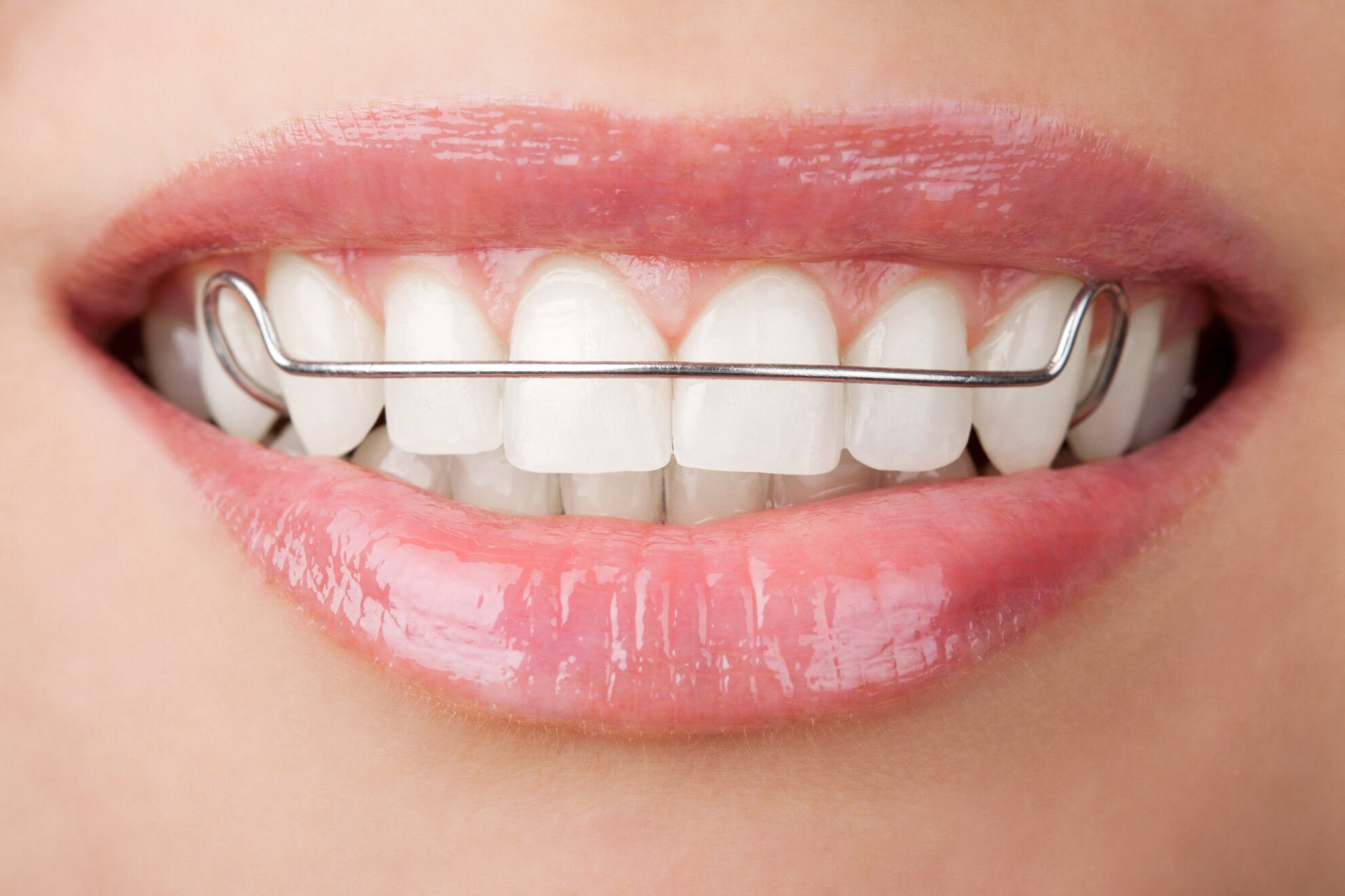 Orthodontic Retainers