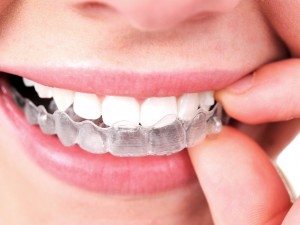 invisalign bucktown