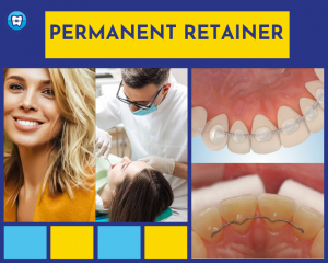 Permanent Retainer