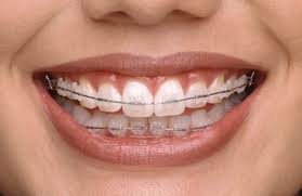 How to Avoid Stained Ceramic Braces