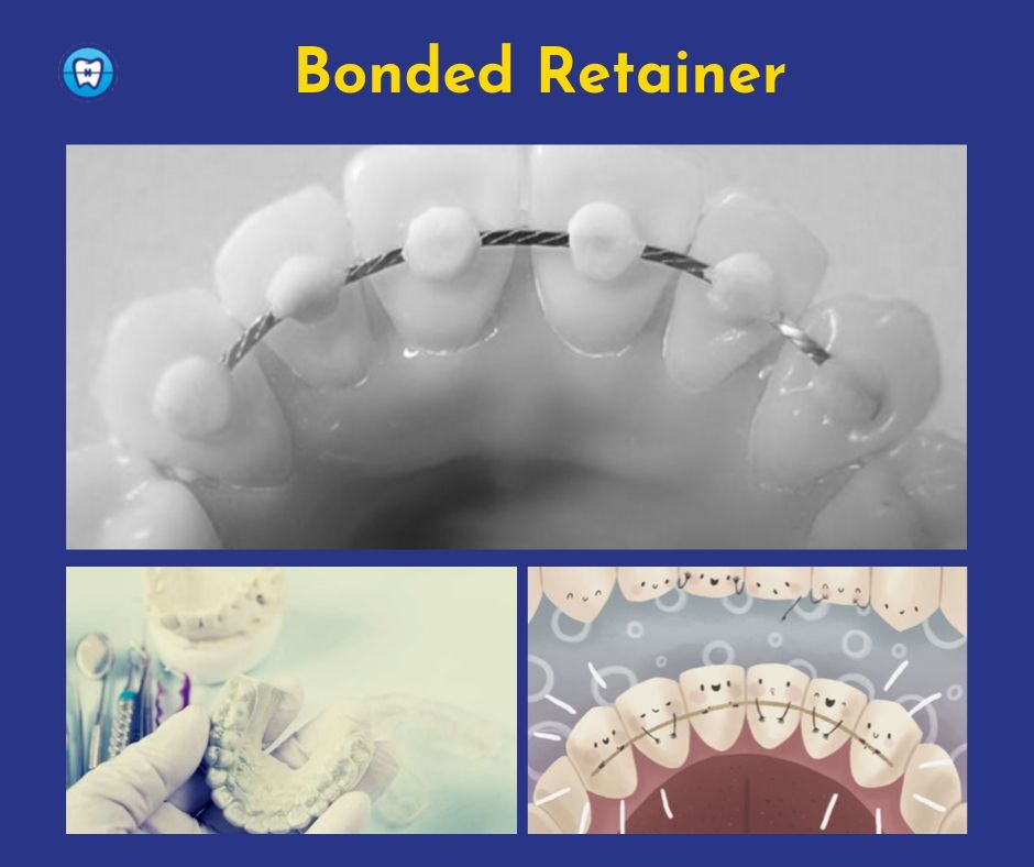 Bonded Retainers