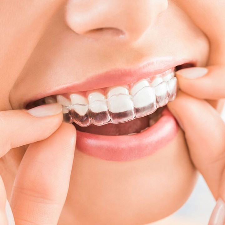clear aligners treatment in lake hills