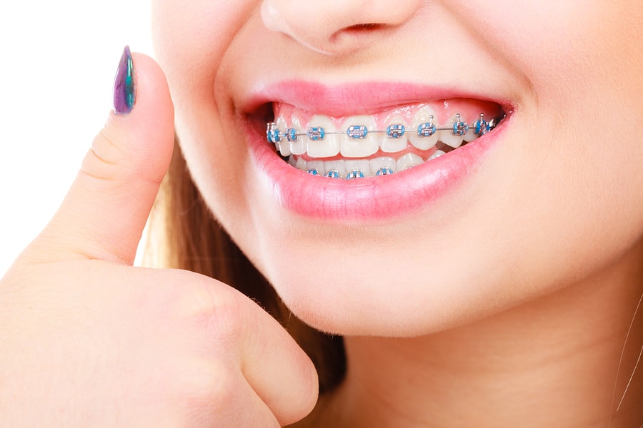 traditional metal braces in lake hills