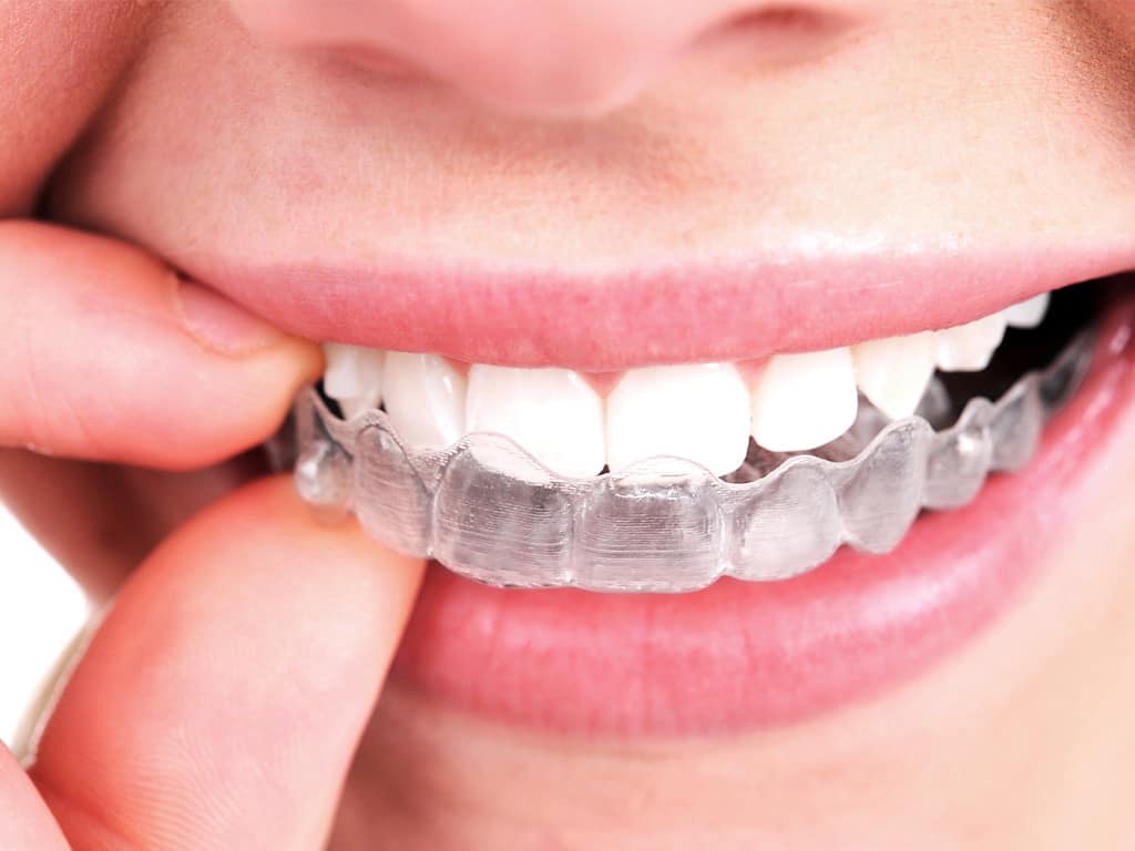 Why Choose Invisalign