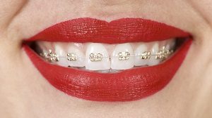 iconix braces