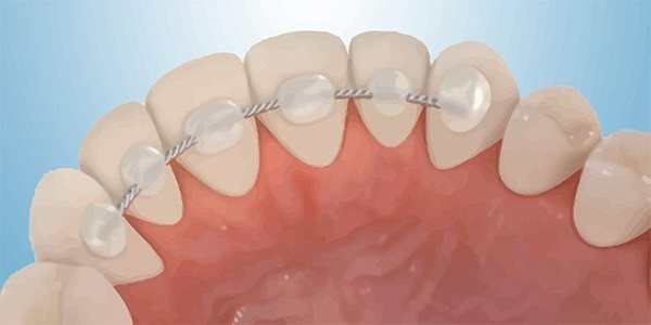 fixed retainer