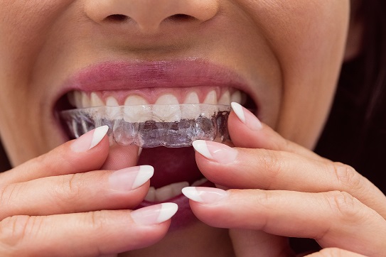 invisalign lake forest