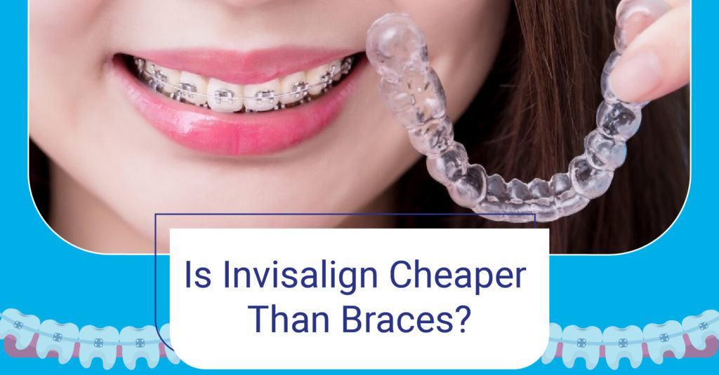 Is Clear Aligners Cheaper Than Braces? Complete Guide