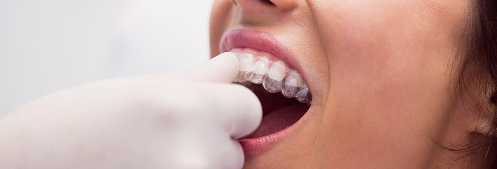 How Long Does It Take To Get Clear Aligners