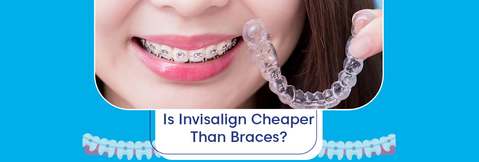 Clear Aligners vs. Braces Which is More Affordable?