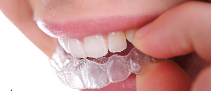 invisalign glen ellyn near glendale heights