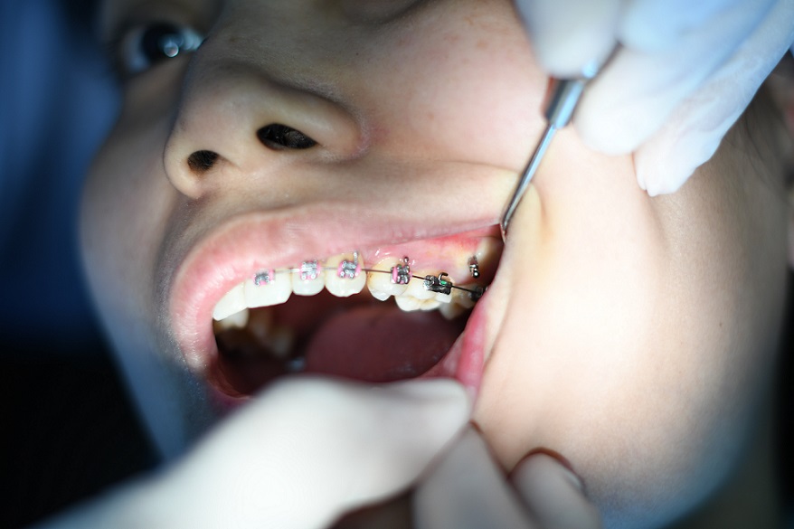 orthodontic treatment in Bartlett