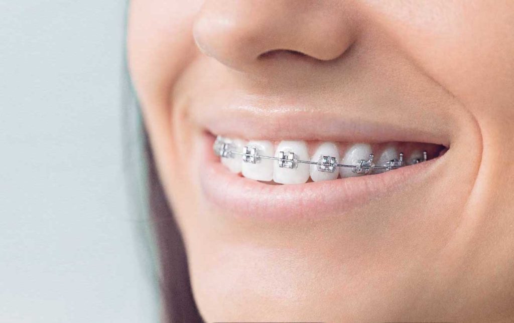 do braces make your lips bigger