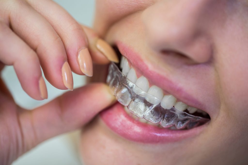 Clear Aligners Treatment