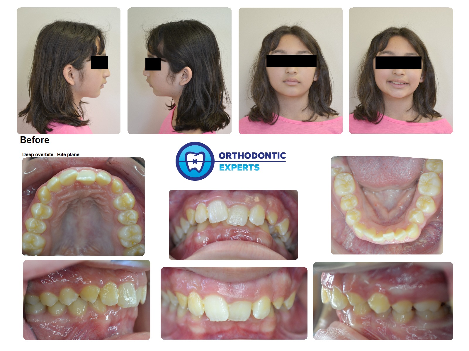 overbite before and after