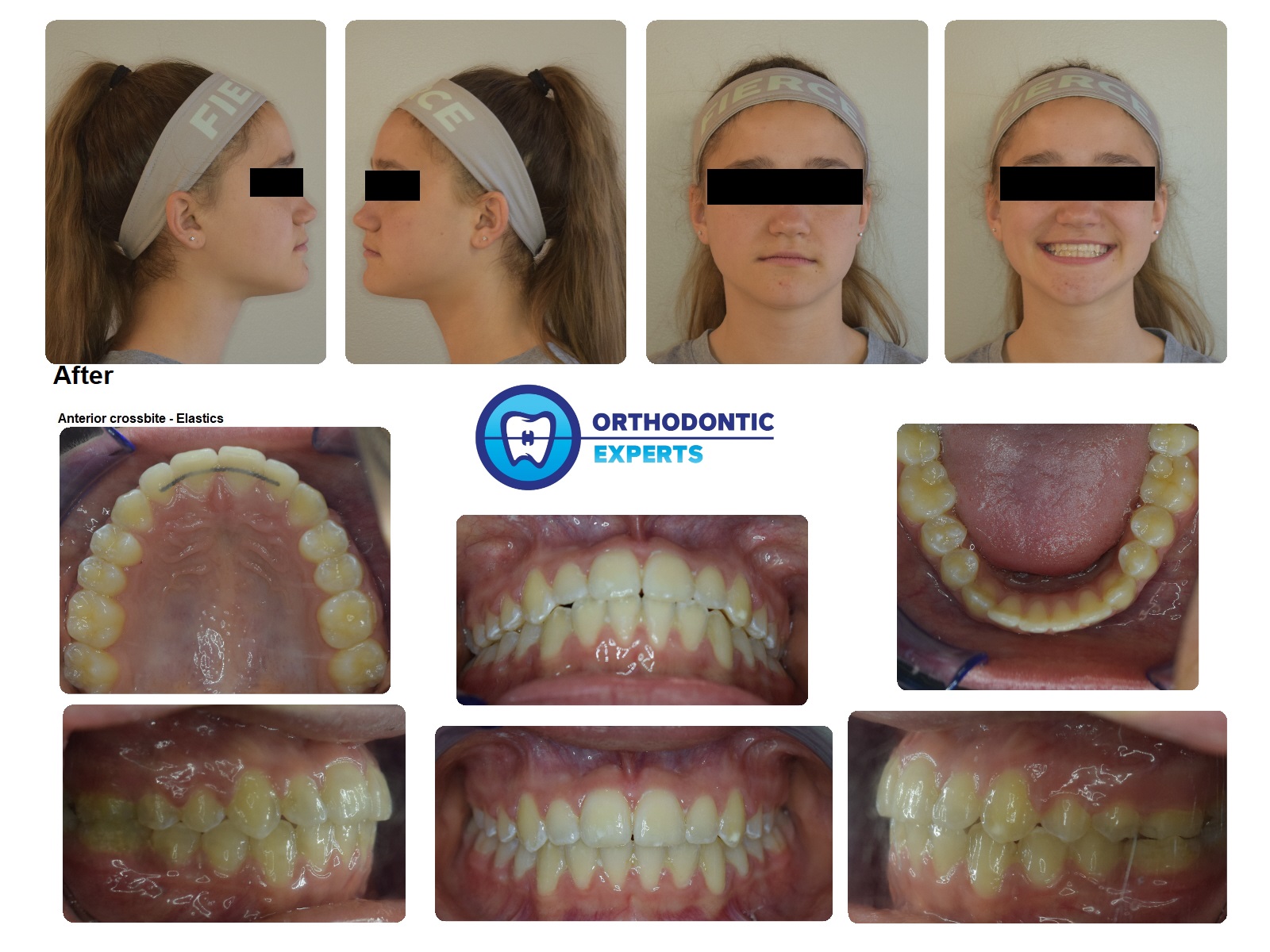 Adult shop braces elastics
